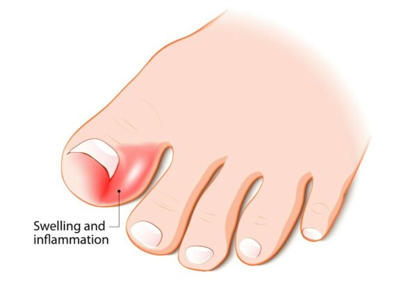 How to Fix Ingrown Toenail Permanently? - Swissklip