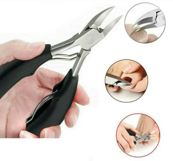 How to Fix Ingrown Toenail Permanently? Swissklip