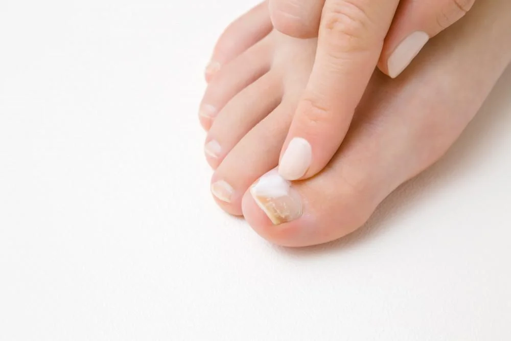 Toenail Fungus Symptoms