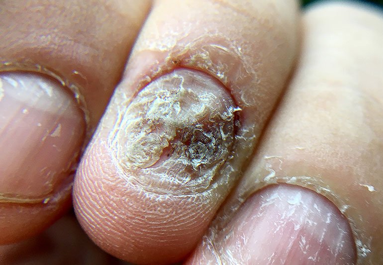How to cut thick toenail - Psoriasis