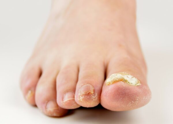 thick toenail causes