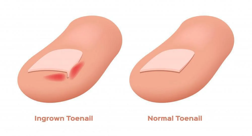 Fix Ingrown Toenail Permanently