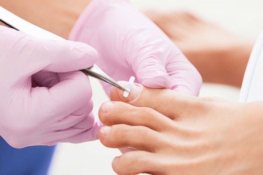 Nonsurgical Ingrown Toenail Treatment Swissklip