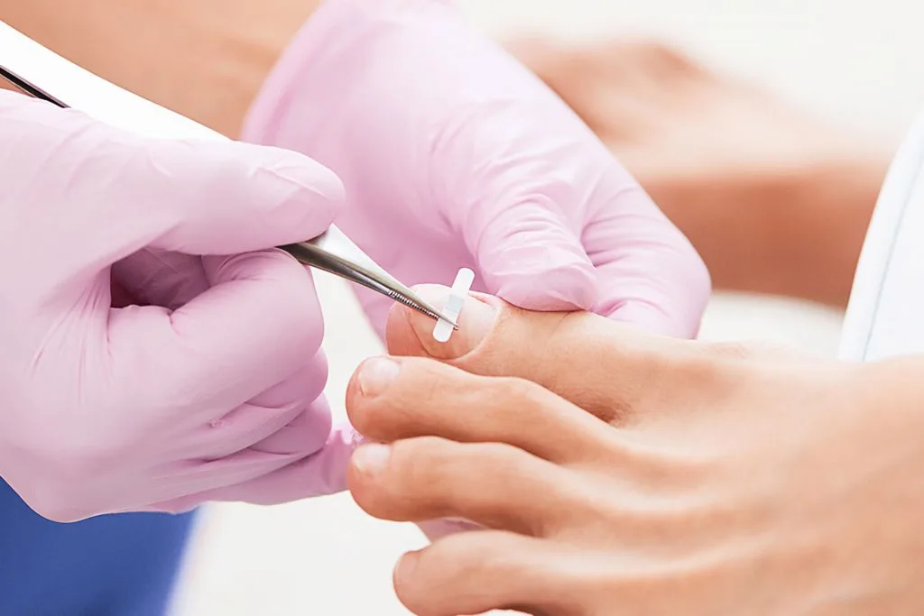 Non-Surgical Toenail Spacer Splint