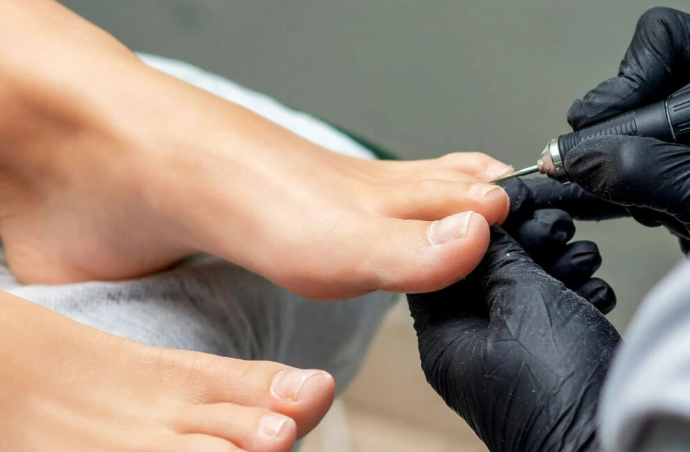 Embarrassed to get a Pedicure with Toenail Fungus? - Swissklip