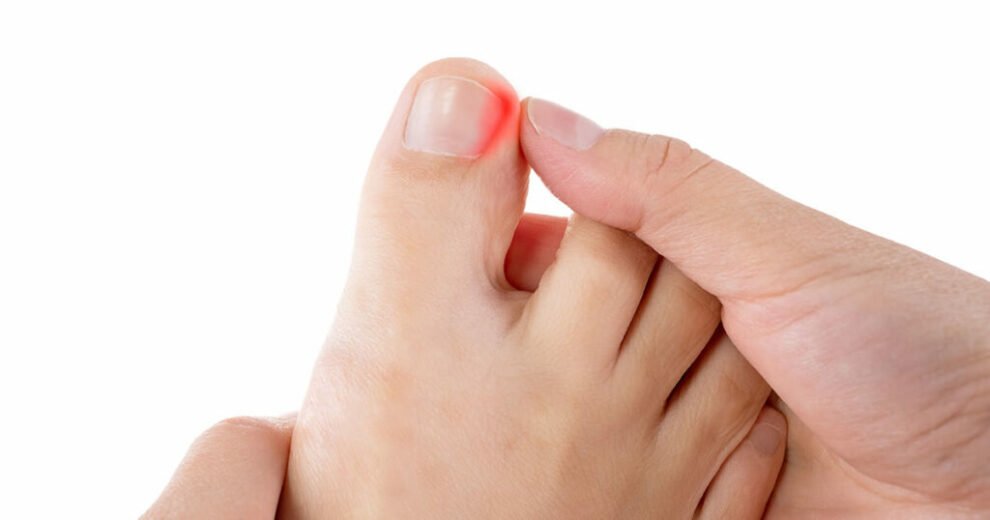 will-an-ingrown-toenail-eventually-grow-out-on-its-own-swissklip