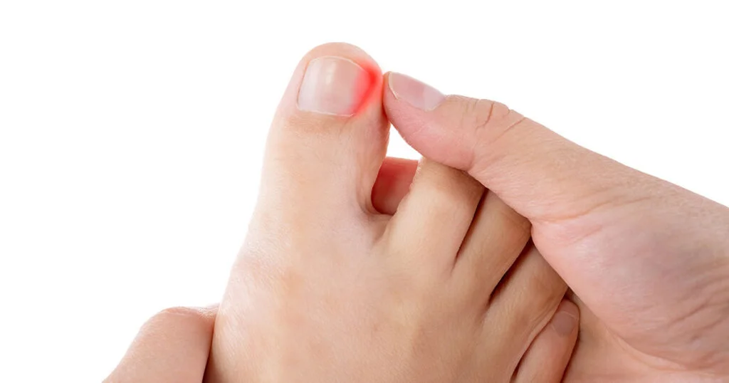 Ingrown Toenail Grow Out