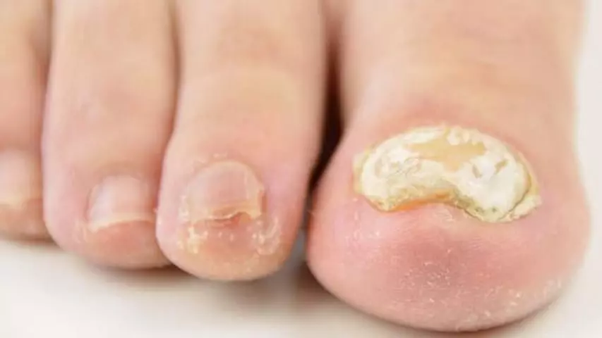 What causes thick toenails