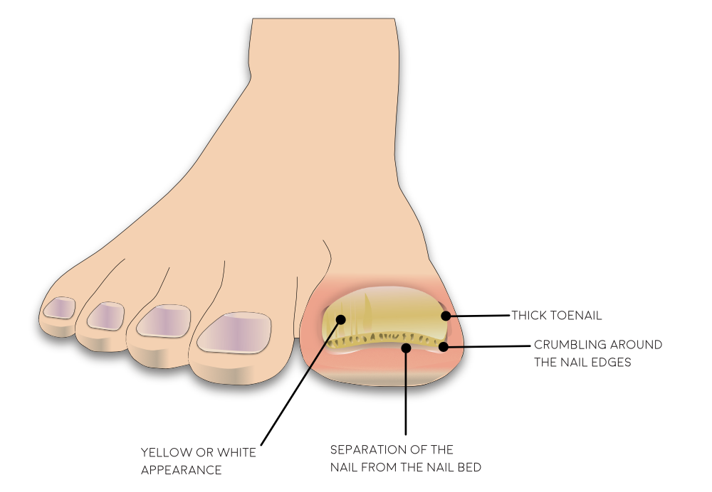 thick toenail causes symptoms