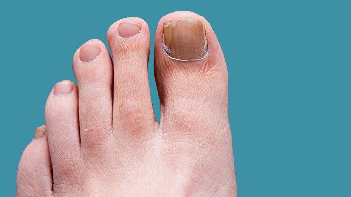 prevent toenail fungus