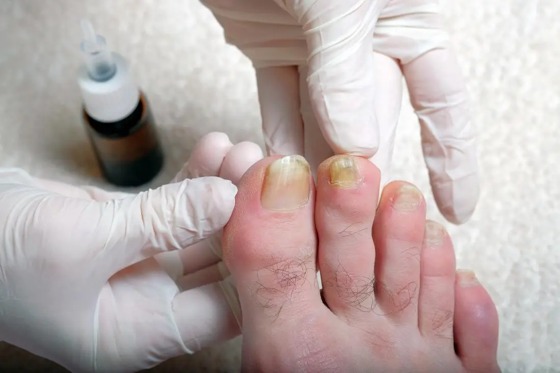 thick toenail causes 03