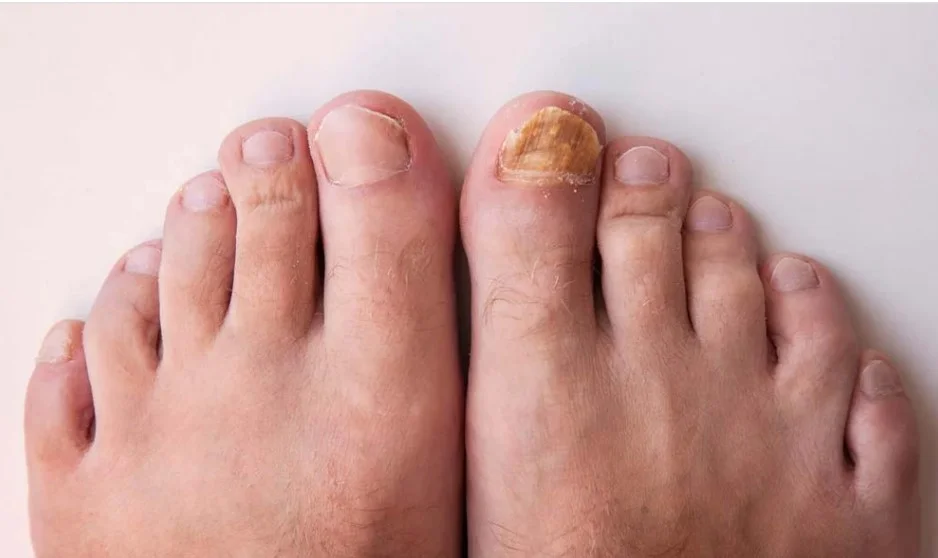 Tea tree oil for toenail fungus