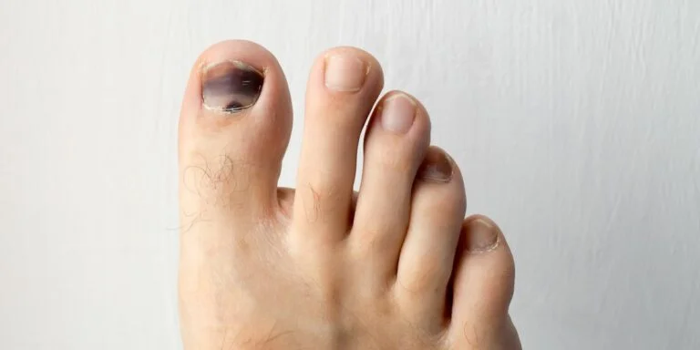 Why my toenail is black