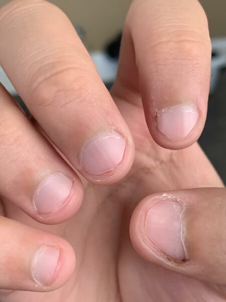 cut nails too short