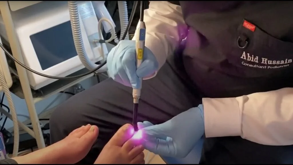 laser-treatment-for-toenail-fungus