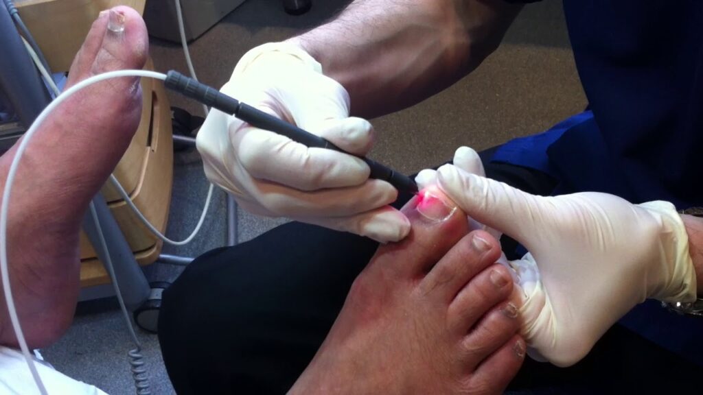 laser-treatment-for-toenail-fungus-04