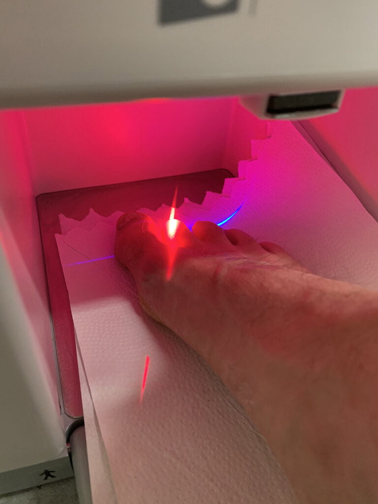 laser-treatment-for-toenail-fungus-05