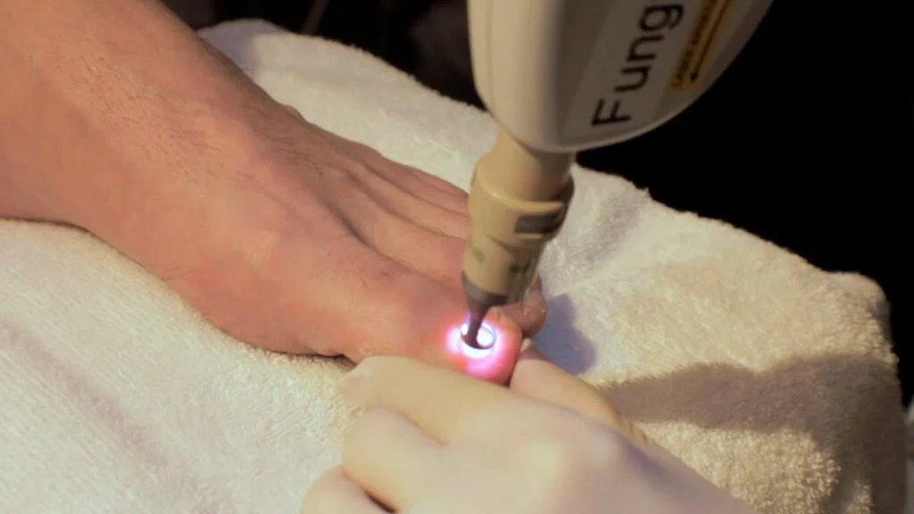 laser-treatment-for-toenail-fungus