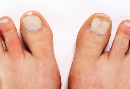 Why Are My Toenails White? - Swissklip