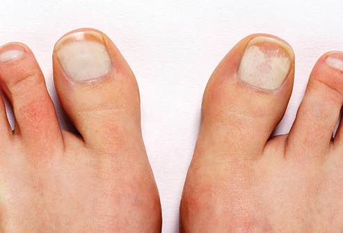 why toenails turning white
