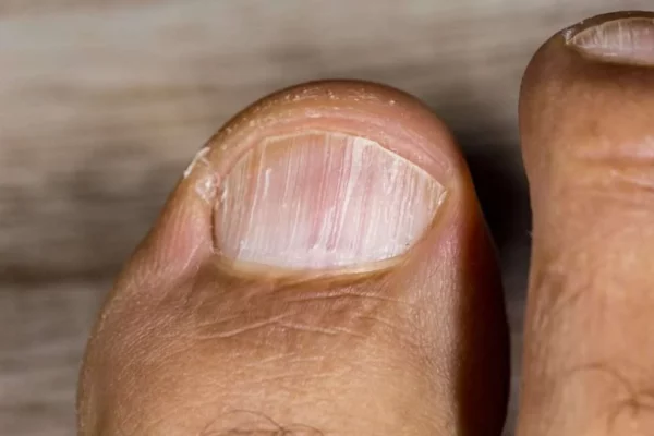 whitelines and streaks in toenails