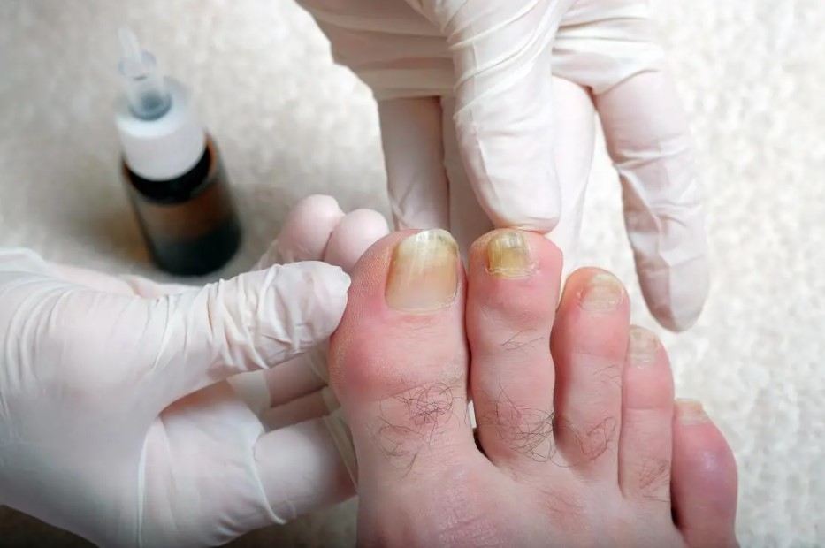 thick toenails treatment and diganosis