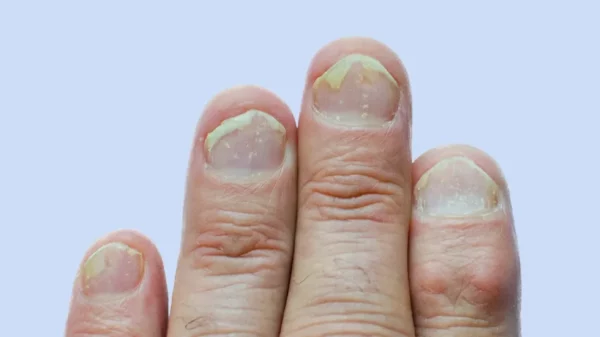 nail psoriasis