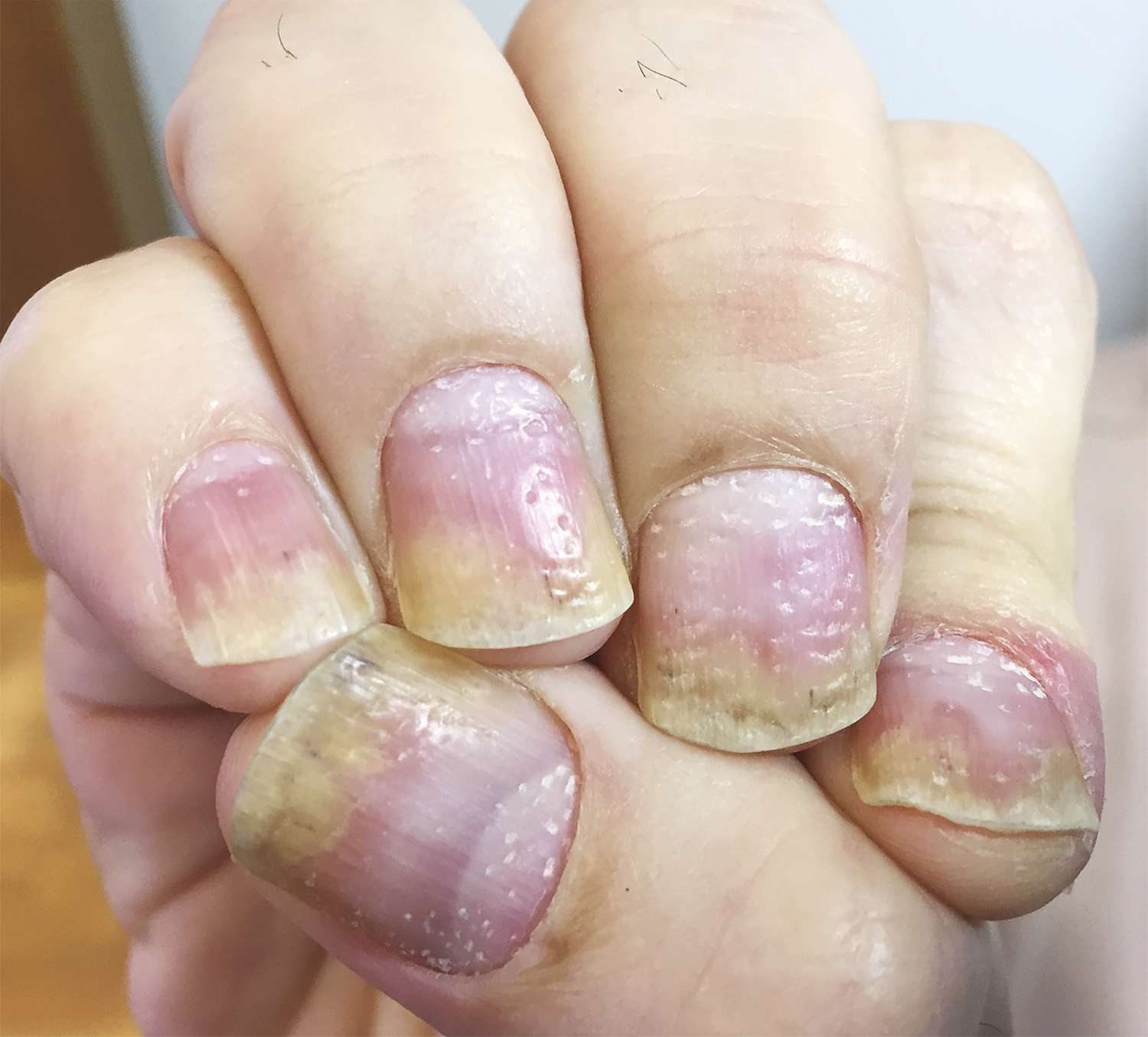 nail psoriasis vs fungus nail pitting