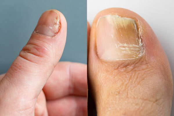 nail psoriasis vs fungus