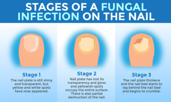 Stages of toenail fungus
