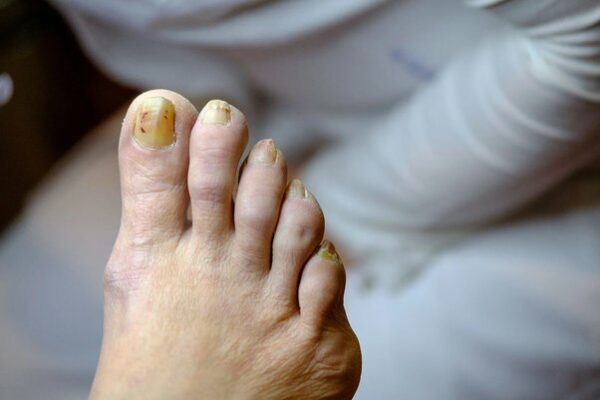 thick toenails in seniors and elderly