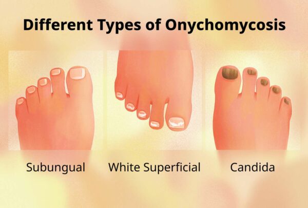 Types of nail fungus onychomychosis
