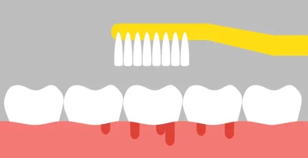 bleeding gums when brushing