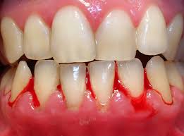 gingivitis my gums bleed when i brush my teeth