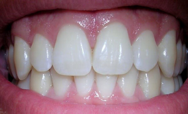 healthy gums color