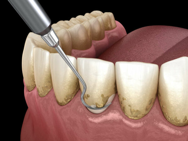 how to remove plaque from teeth