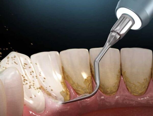 remove plaque from teeth at home