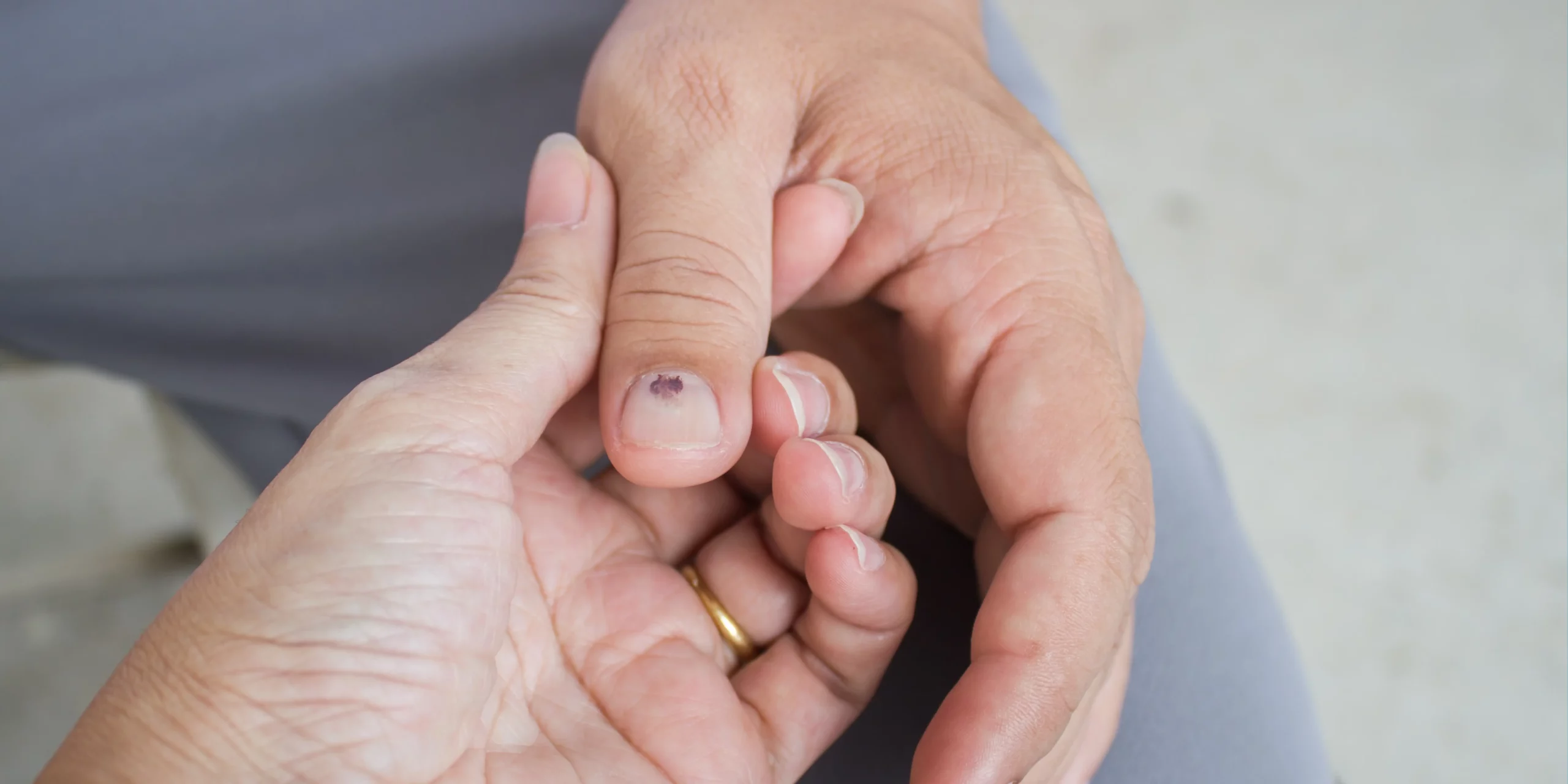 nail bruise vs nail fungus
