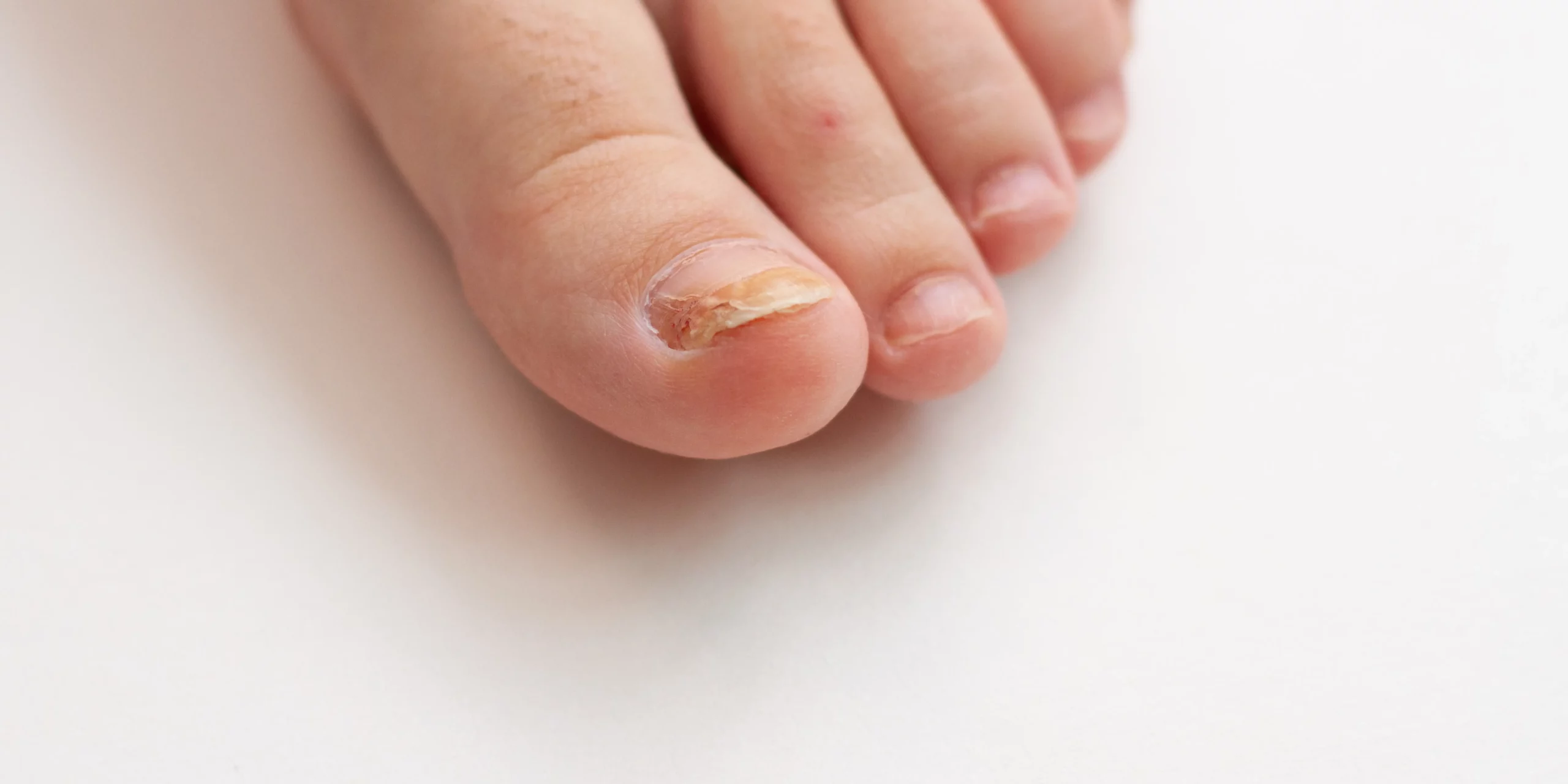 stages of toe nail fungus