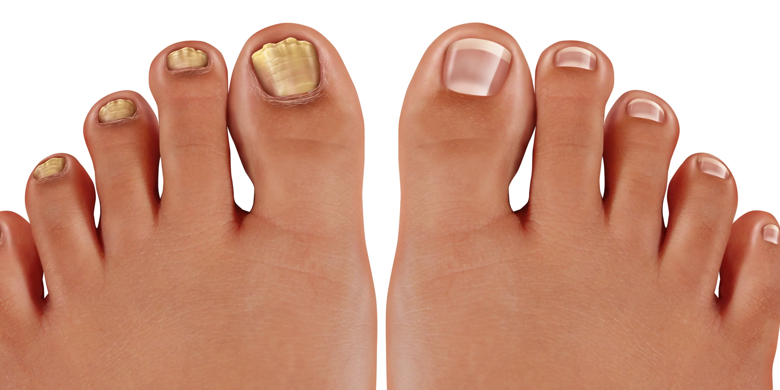 toenail discoloration